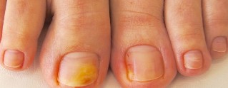onddo toenails sintomak